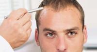 Что такое выпадение волос по мужскому типу и можно ли его вылечить?