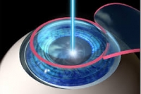  LASIK:    